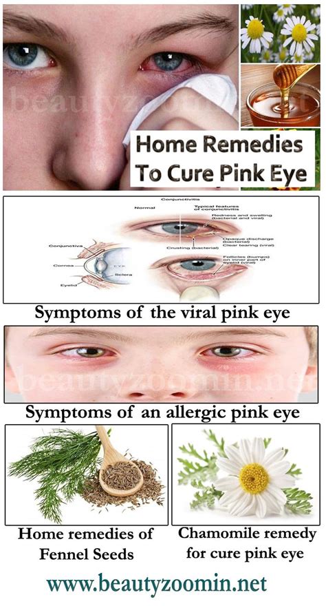 Fast And Easy Home Remedies To Cure Pink Eye And Itching in 2021 | Pink ...