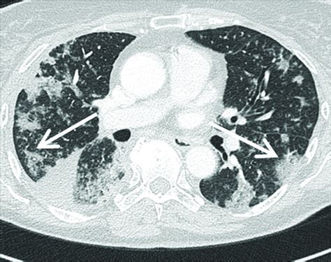 The many faces of cryptogenic organizing pneumonia (COP) - Journal of Clinical Imaging Science