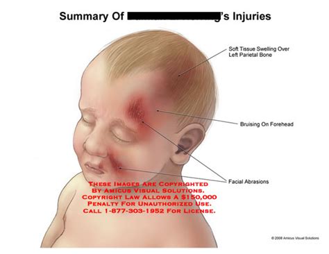 Summary of Injuries