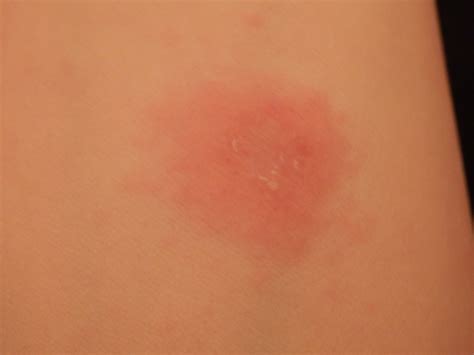 I have a few dozen red very itchy bumps on both of my legs. I cant help but itch them, though I ...