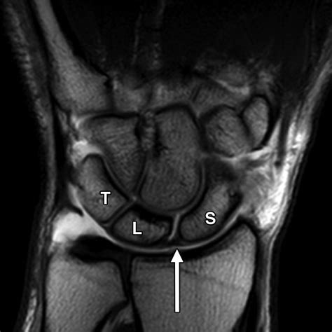 Ulnar Collateral Ligament Wrist Mri