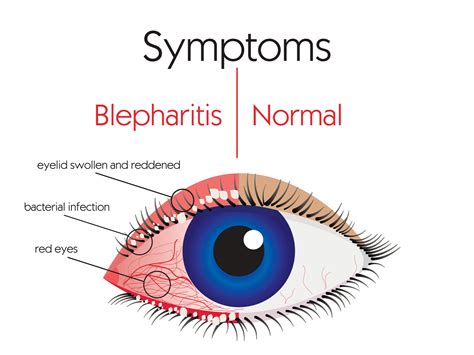 Dry Eyelids Causes