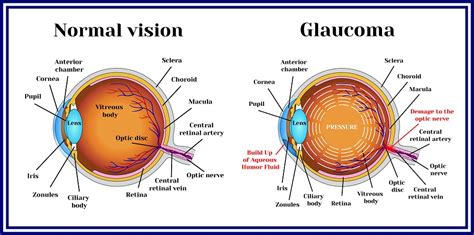 What Are the Symptoms of Narrow Angle Glaucoma? | Fort Lauderdale Eye Institute