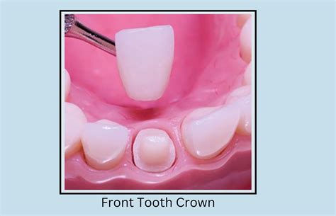 Front Tooth Crown -Types, Procedure, and Care - Oral Health Line