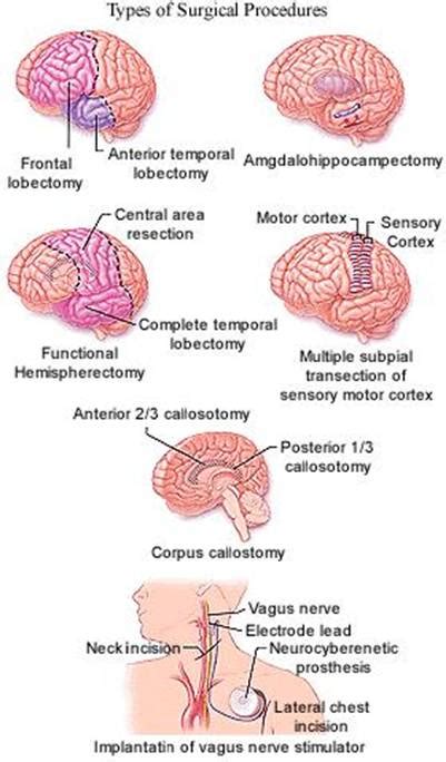 Epilepsy,Epilepsy India,Surgery India Epilepsy,Cost Epilepsy Treatment