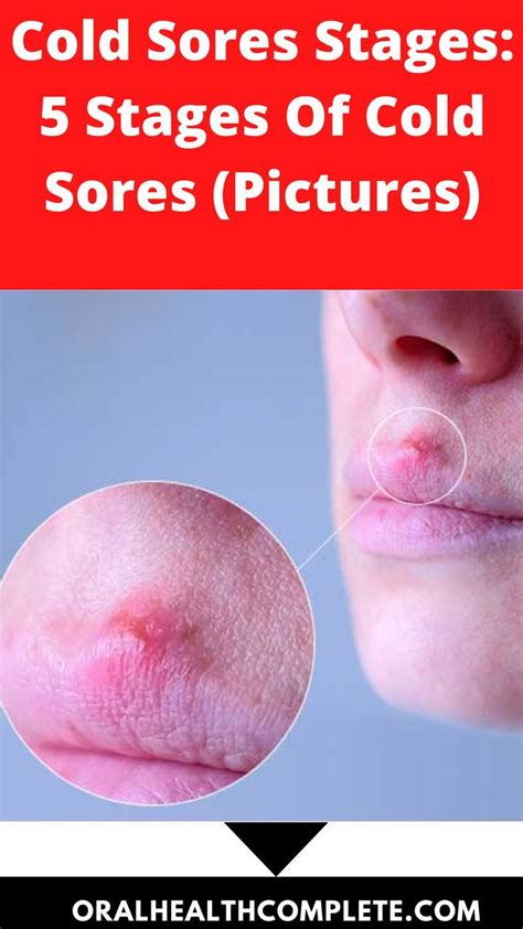 Cold Sores Stages: 5 Stages Of Cold Sores (Pictures) | Cold sore, Cold sore stages, Soreness