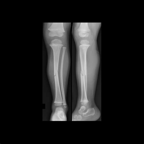 Pediatric Complete Fracture | Pediatric Radiology Reference Article ...