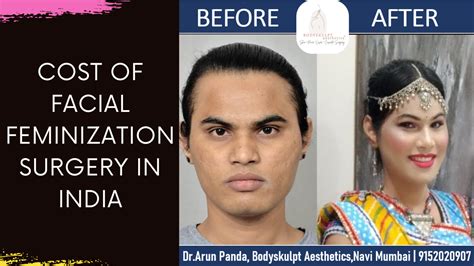 Cost of Facial Feminization Surgery in India | Price of Transgender