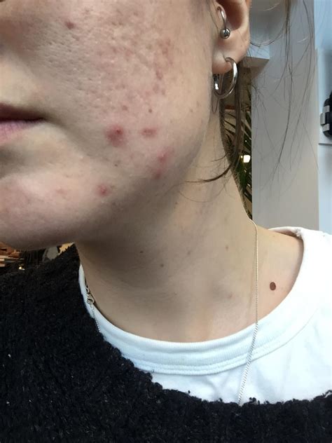 [Acne] Differin purge – how long did yours last? : r/SkincareAddiction