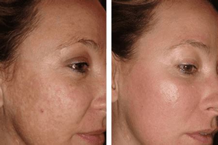 Learn About Laser Resurfacing for Acne Scars: Essence Medispa: Cosmetic Dermatology