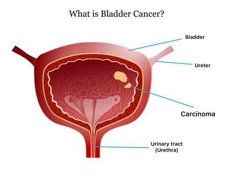 Comprehensive Bladder Cancer Guide: Symptoms, Treatments, and Risks