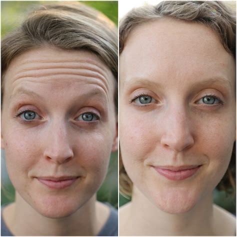 Before & After Botox | Jesse Coulter