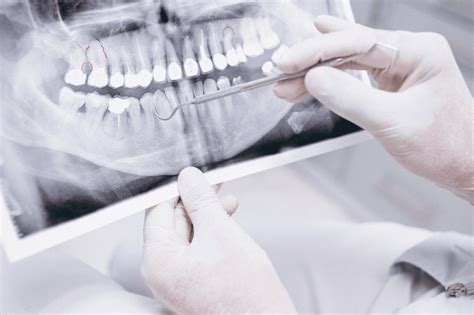 3 Benefits of Dental X-Rays | Hearts Dental Blackburn