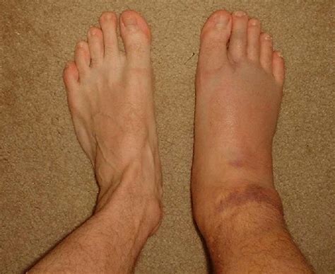 Swollen Ankles - Treatment, Pictures, Pregnancy, Symptoms, Causes ...