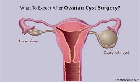 What to Expect After Ovarian Cyst Surgery - Health Checkup