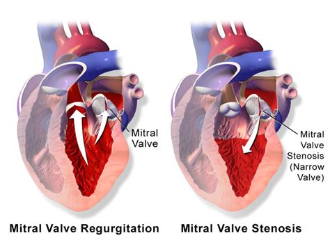 Mitral Valve Regurgitation