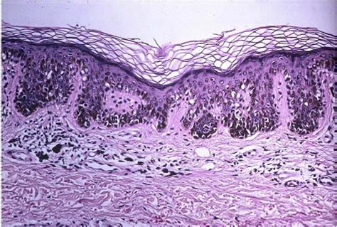 Figure 3 from The "dysplastic" nevus. | Semantic Scholar