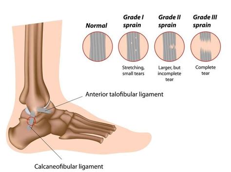 Ankle Sprain Treatment for a Complete Sprained Ankle Recovery