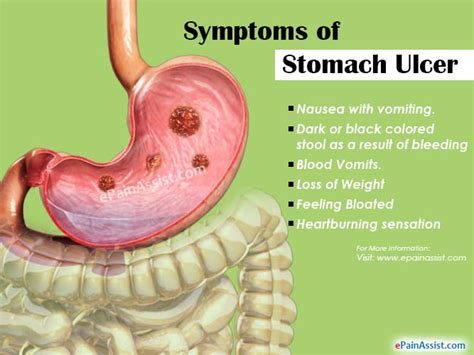 8 Foods You Should Avoid If You Have Stomach Ulcer - TheScript Nigeria