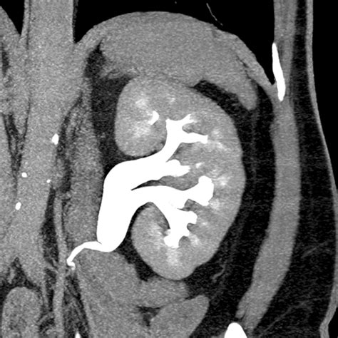 Normal Kidney Anatomy