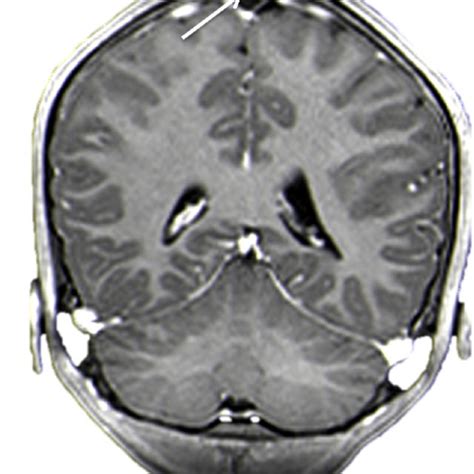 (PDF) Giant Arachnoid Granulation Associated with Anomalous Draining Vein: A Case Report