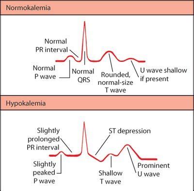 12 best images about ECG interpretation, etc on Pinterest | Cartoon ...