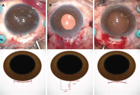 Representative photographs during the surgery and a schematic... | Download Scientific Diagram