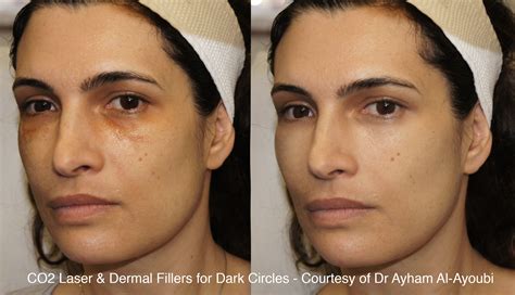 CO2 Laser Skin Resurfacing London, Before & After Pics (UK’s Best Clinic)