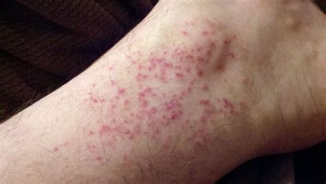 Diabetic rash on legs pictures | Symptoms and pictures