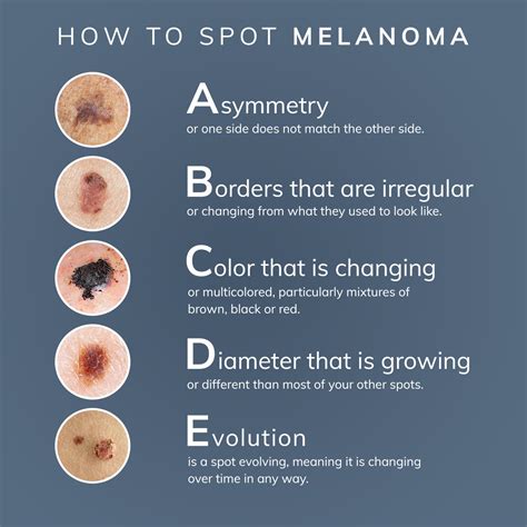 Melanoma - ObehiOduname