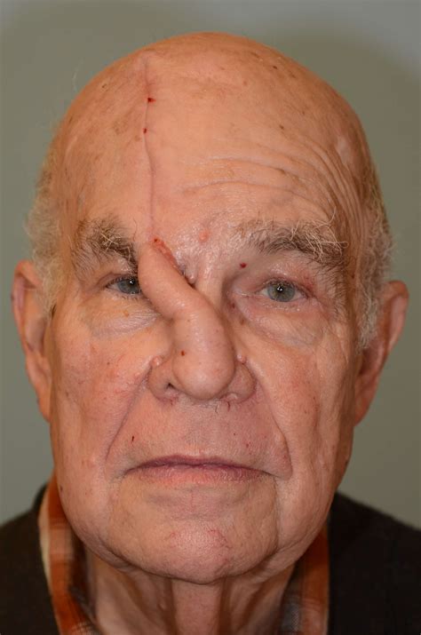 Forehead Flap Reconstruction of Nasal Tip following MOHs