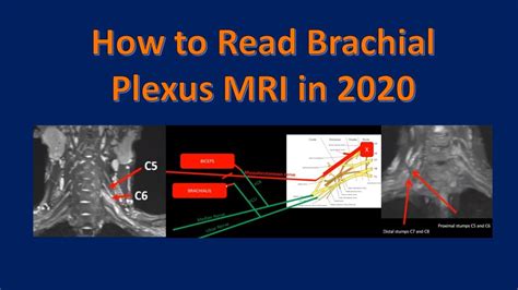 Brachial Plexus Injury Mri