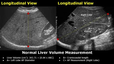 Normal Liver Ultrasound