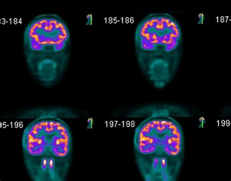 Brain PET scan