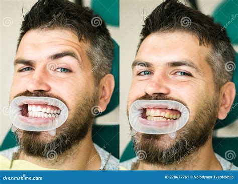 White Teeth - before and after Concept. Close-up Detail of Man Teeth before and after Whitening ...