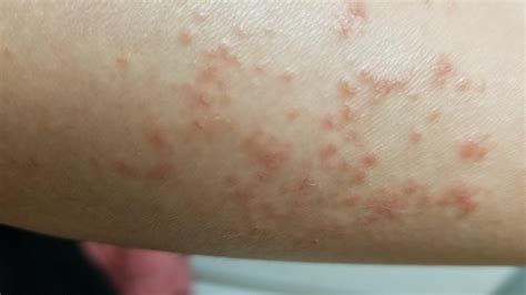 HELPp! I have this red bumpy acne rash on my forearm that sting when place on hard surface but ...