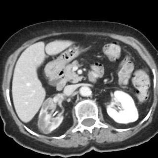 -Contrast-enhanced abdominal CT scan showing nonvascularized right kidney. | Download Scientific ...