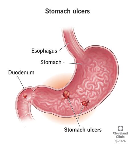 Stomach (Peptic) Ulcer: Signs, Symptoms, Causes & Treatment