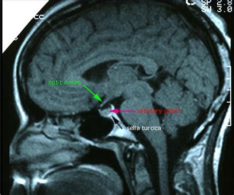 Radiology Anatomy Images : Optic nerve MRI Anatomy