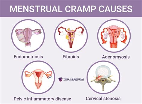 Severe Menstrual Cramps - Vein & Endovascular Medical Care