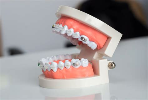 Do Teeth Shift After Wisdom Teeth Removal? - Lane & Associates