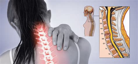 Cervical Disc Herniation Exercises