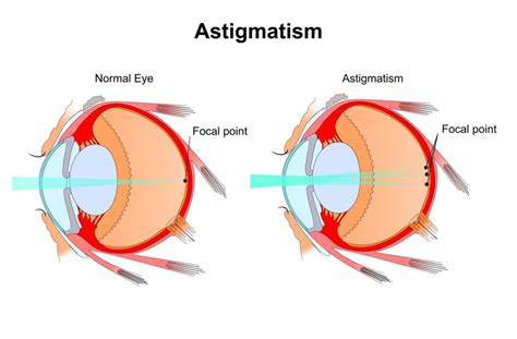 What Are the Best Contact Lenses for Astigmatism?