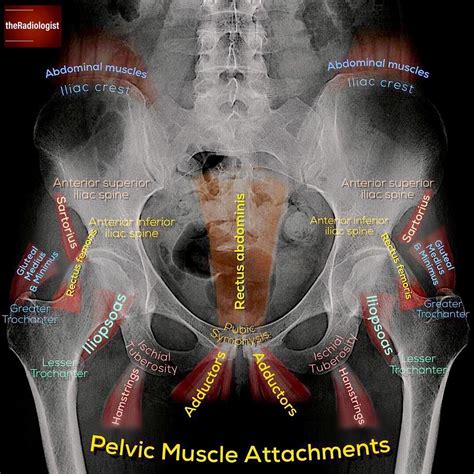 👨‍💻Pelvic muscle attachments ⠀⠀⠀⠀⠀⠀⠀⠀⠀ A classic exam question! ⠀⠀⠀⠀⠀⠀⠀⠀⠀ 1️⃣Multiple abdominal ...