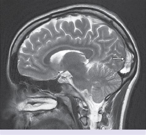 [PDF] Giant arachnoid granulation mimicking dural sinus thrombosis | Semantic Scholar