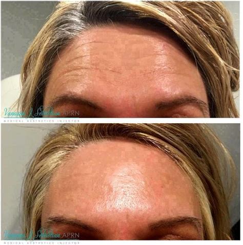 Botox Before And After Pics Forehead (5) » Facelift: Info, Prices, Photos, Reviews, Q&A