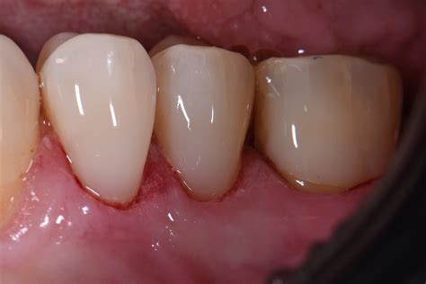 Cervical Abrasion | Toothbrush Abrasion | Restorative Dentistry ...