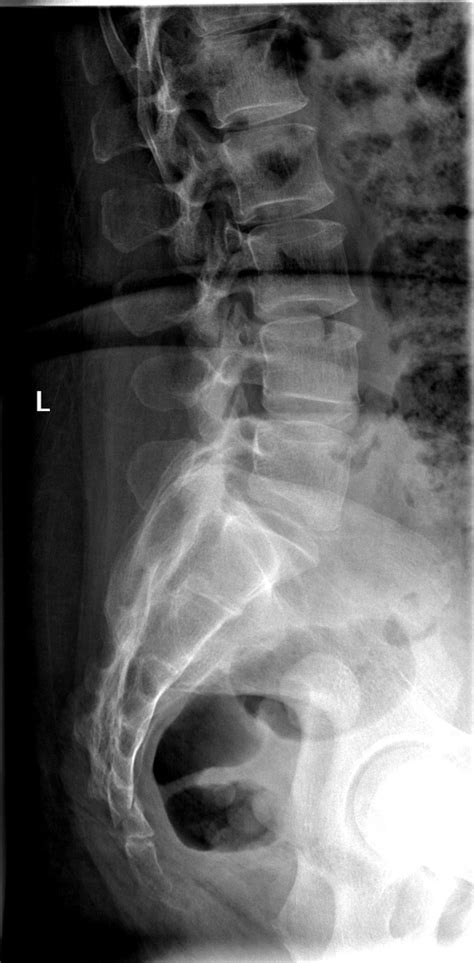 Sacrum Xray