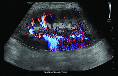 Ultrasound demonstrating improved renal parenchyma perfusion following ...