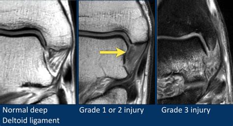 Deltoid Ligament Mri